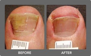 nail fungus treatment before and after image